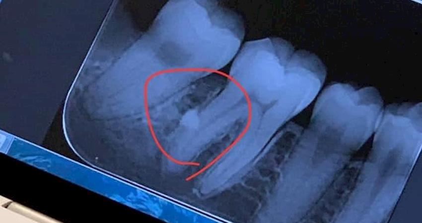拔智齒碎片卻出現在大臼齒牙根，病患指控牙醫疏失害她發炎兩個多月還態度很差！診所也提出聲明回應