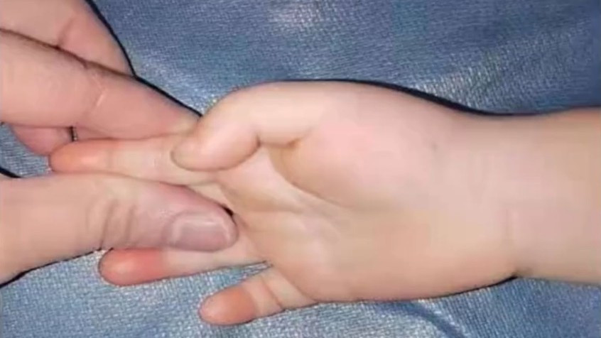 ▲▼3歲女童大拇指伸不直（圖／翻攝自新浪視頻）