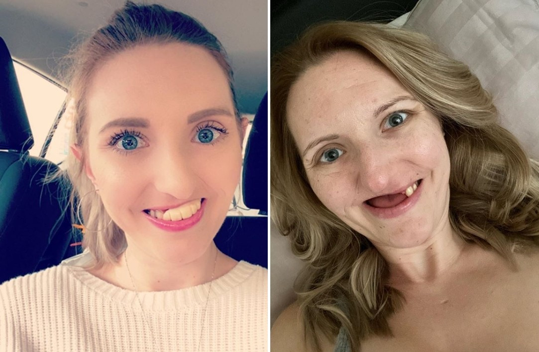 ▲▼28歲女子罹癌拔11顆牙齒，容貌大不同。（圖／翻攝自Instagram／nicolescrookedsmile）
